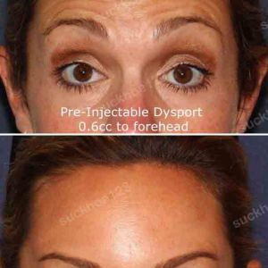 Hình ảnh tiêm Botox trước sau Dr Tâm – ca 17