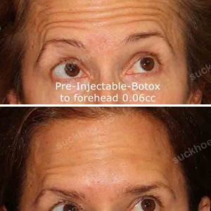 Hình ảnh tiêm Botox trước sau Dr Tâm – ca 18