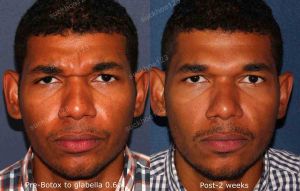 Hình ảnh tiêm Botox trước sau Dr Tâm – ca 19