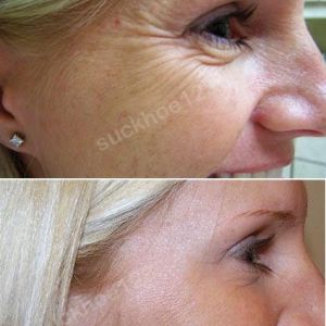 Hình ảnh tiêm Botox trước sau Dr Tâm – ca 2