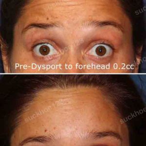 Hình ảnh tiêm Botox trước sau Dr Tâm – ca 20