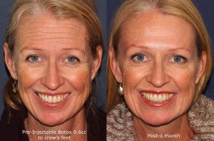 Hình ảnh tiêm Botox trước sau Dr Tâm – ca 21