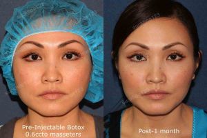 Hình ảnh tiêm Botox trước sau Dr Tâm – ca 22