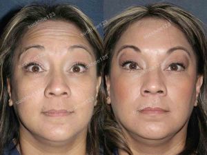 Hình ảnh tiêm Botox trước sau Dr Tâm – ca 23