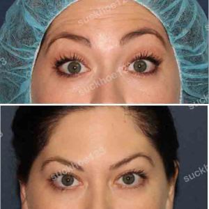 Hình ảnh tiêm Botox trước sau Dr Tâm – ca 24