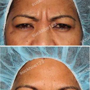 Hình ảnh tiêm Botox trước sau Dr Tâm – ca 25