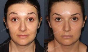 Hình ảnh tiêm Botox trước sau Dr Tâm – ca 26