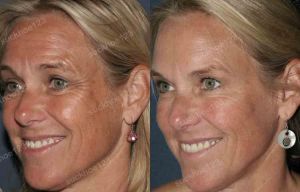 Hình ảnh tiêm Botox trước sau Dr Tâm – ca 28