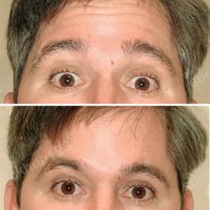 Hình ảnh tiêm Botox trước sau Dr Tâm – ca 3