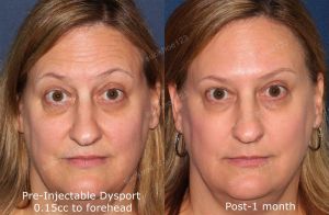 Hình ảnh tiêm Botox điều trị cười hở lợi Dr Tâm – ca 30