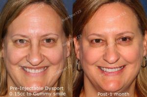 Hình ảnh tiêm Botox điều trị cười hở lợi Dr Tâm – ca 30