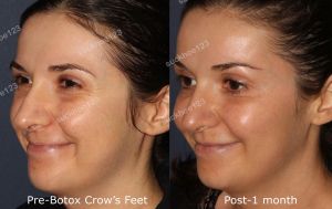 Hình ảnh tiêm Botox trước sau Dr Tâm – ca 31