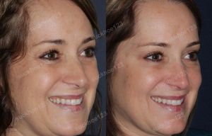 Hình ảnh tiêm Botox trước sau Dr Tâm – ca 32