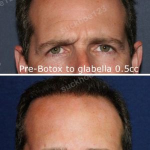 Hình ảnh tiêm Botox trước sau Dr Tâm – ca 35