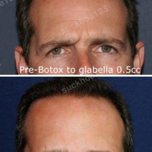 Hình ảnh tiêm Botox trước sau Dr Tâm – ca 35