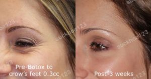 Hình ảnh tiêm Botox trước sau Dr Tâm – ca 36