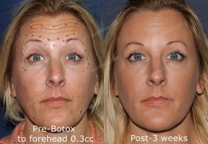 Hình ảnh tiêm Botox trước sau Dr Tâm – ca 37