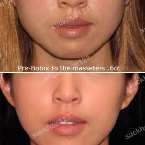 Hình ảnh tiêm Botox trước sau Dr Tâm – ca 38