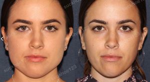 Hình ảnh tiêm Botox trước sau Dr Tâm – ca 39