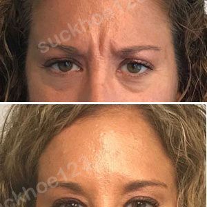 Hình ảnh tiêm Botox trước sau Dr Tâm – ca 4