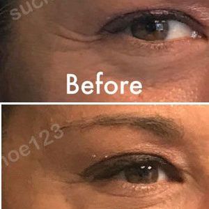 Hình ảnh tiêm Botox trước sau Dr Tâm – ca 4