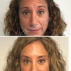 Hình ảnh tiêm Botox trước sau Dr Tâm – ca 4