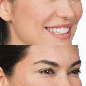 Hình ảnh tiêm Botox trước sau Dr Tâm – ca 5