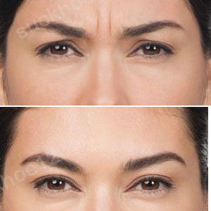 Hình ảnh tiêm Botox trước sau Dr Tâm – ca 5