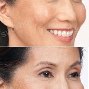 Hình ảnh tiêm Botox trước sau Dr Tâm – ca 7