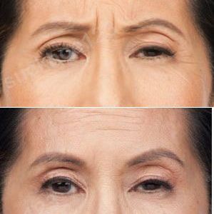Hình ảnh tiêm Botox trước sau Dr Tâm – ca 7