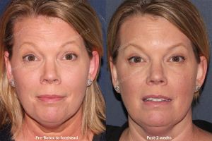Hình ảnh tiêm Botox trước sau Dr Tâm – ca 9