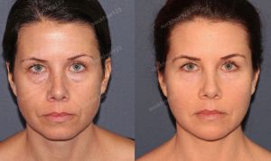 Hình ảnh tiêm kết hợp botox, filler Voluma và Laser CO2 tái tạo bề mặt da