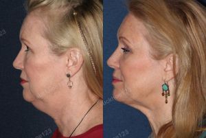 Hình ảnh tiêm Kybella trước sau Dr Tâm - ca 1