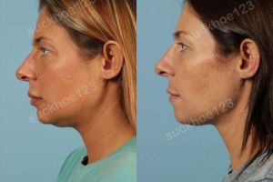 Hình ảnh tiêm Kybella trước sau Dr Tâm - ca 10