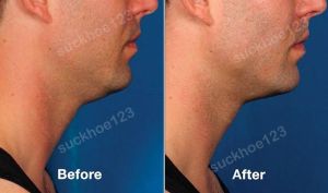 Hình ảnh tiêm Kybella trước sau Dr Tâm - ca 15