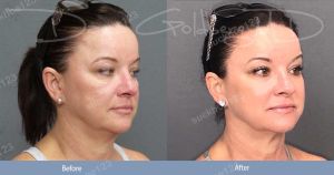 Hình ảnh tiêm Kybella trước sau Dr Tâm - ca 16