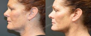 Hình ảnh tiêm Kybella trước sau Dr Tâm - ca 17