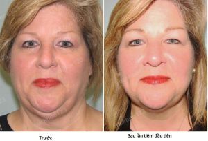 Hình ảnh tiêm Kybella trước sau Dr Tâm - ca 18