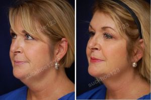 Hình ảnh tiêm Kybella trước sau Dr Tâm - ca 20