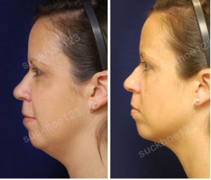 Hình ảnh tiêm Kybella trước sau Dr Tâm - ca 21