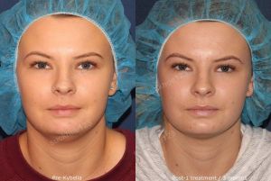 Hình ảnh tiêm Kybella trước sau Dr Tâm - ca 3