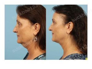 Hình ảnh tiêm Kybella trước sau Dr Tâm - ca 4