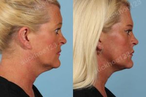 Hình ảnh tiêm Kybella trước sau Dr Tâm - ca 5