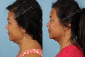 Hình ảnh tiêm Kybella trước sau Dr Tâm - ca 7