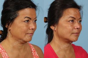 Hình ảnh tiêm Kybella trước sau Dr Tâm - ca 7