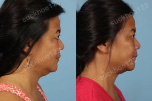Hình ảnh tiêm Kybella trước sau Dr Tâm - ca 7