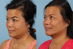 Hình ảnh tiêm Kybella trước sau Dr Tâm - ca 7