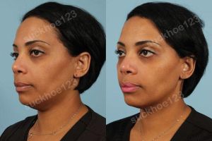 Hình ảnh tiêm Kybella trước sau Dr Tâm - ca 9
