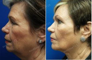 Hình ảnh Ultherapy - Hifu  trước sau Dr Tâm – ca 10