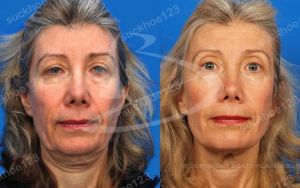 Hình ảnh Ultherapy - Hifu  trước sau Dr Tâm – ca 13